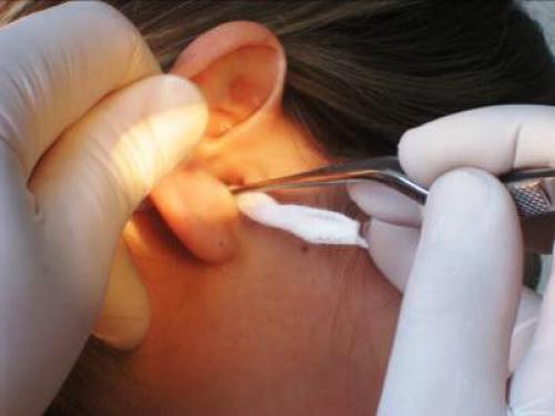 Турундочки в ухо при отите. Использование турунд для лечения ушей