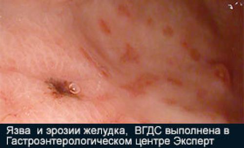 Как восстановить защитные свойства желудка.. Что делать при повышенной кислотности желудка 03