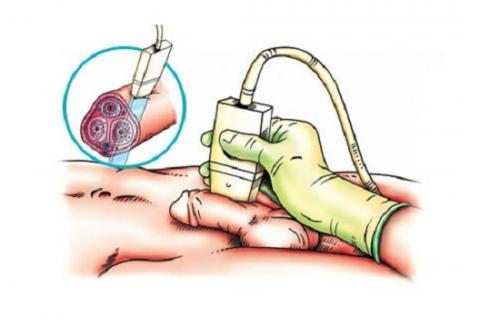 Эффективное лечение импотенции у мужчин. Осложнения 01 Эффективное лечение импотенции у мужчин. Осложнения 01