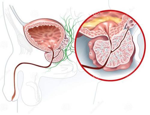 Как вылечить аденому предстательной железы. Причины развития аденомы предстательной железы 03 Как вылечить аденому предстательной железы. Причины развития аденомы предстательной железы 03